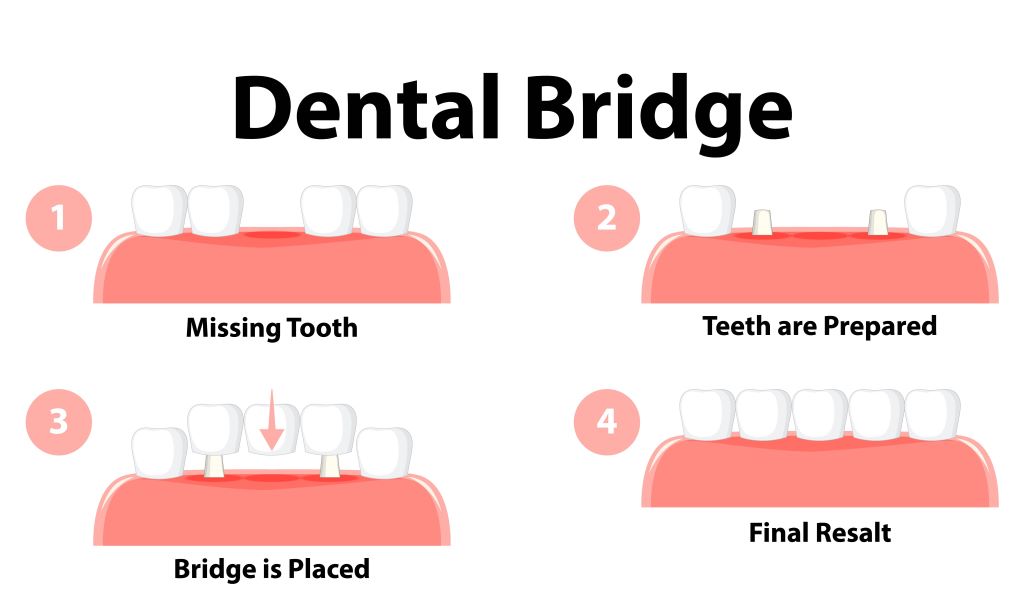 dental bridges elgin