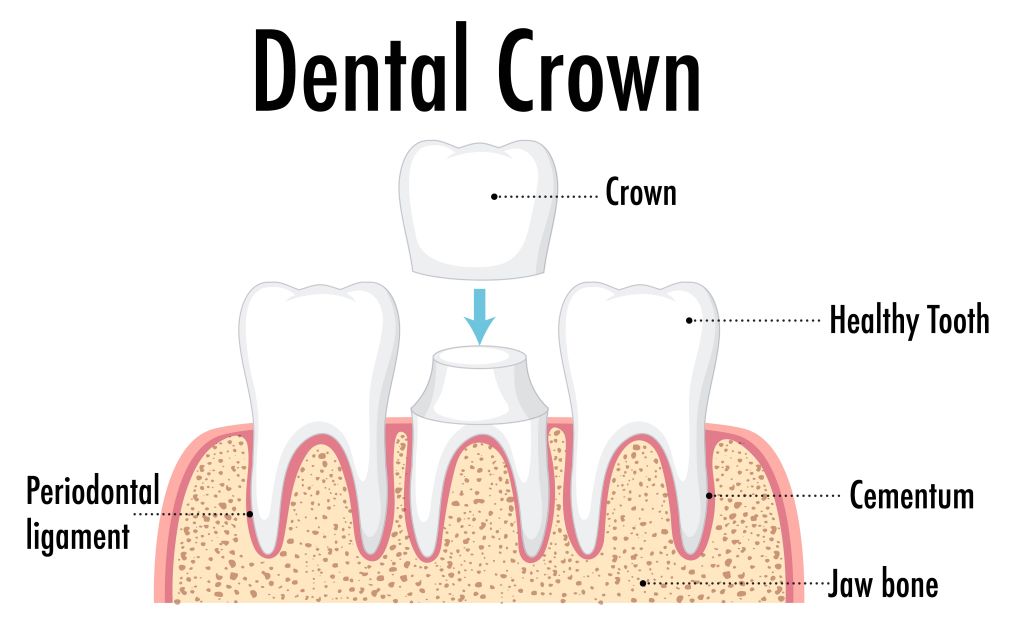 dental crowns elgin