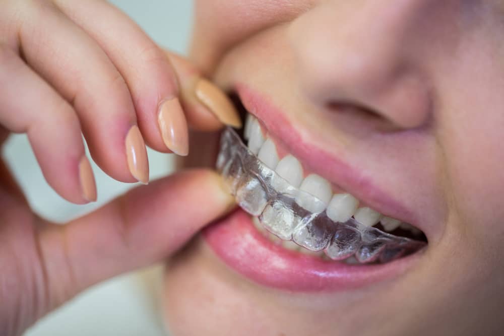 invisalign elgin