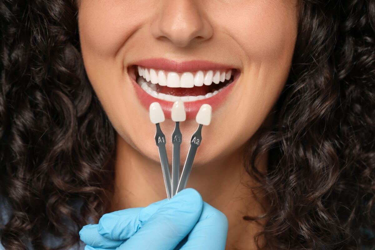 natural looking veneers for a confident smile