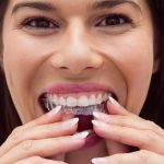 clear aligners vs invisalign are they really different