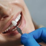 dental veneers how many teeth should you get done at once