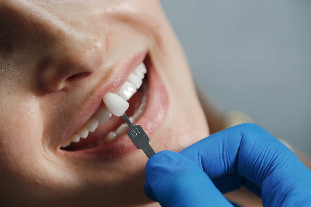 dental veneers how many teeth should you get done at once